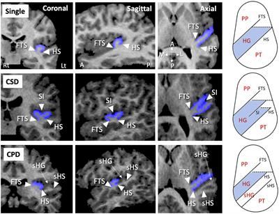 Heschl’s gyrus duplication pattern and clinical characteristics in borderline personality disorder: A preliminary study